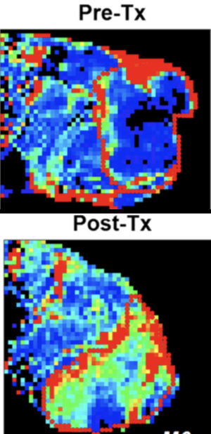 Pre-treatment and post-treatment MRI parameter maps of a tumor, illustrating treatment response